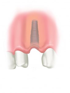 Illustration of dental implant and crown