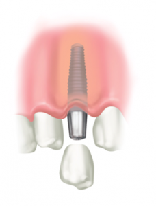 Replace missing teeth with implants