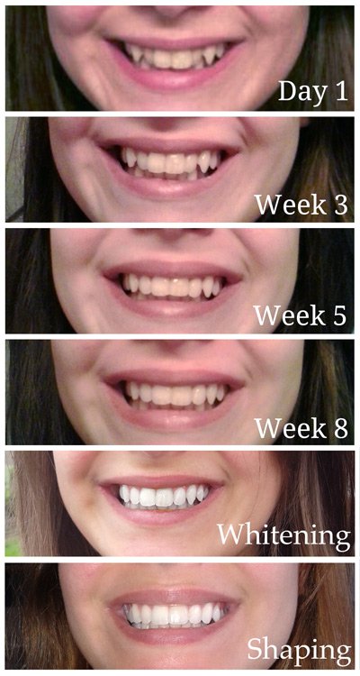 Smile Makeover Edinburgh Inman Aligner Edinburgh