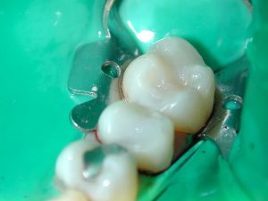 2 teeth with white fillings replacing amalgam