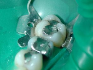 3 teeth with amalgam fillings