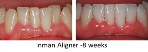 Inman Aligner Before and After 