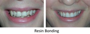 Composite bonding to improve the appearance of teeth