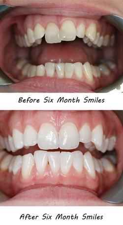 six-month-smiles-Edinburgh2