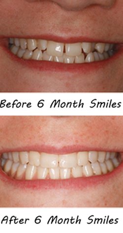 six-month-smiles-before-after2 Six Month Smiles Edinburgh