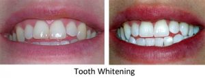 Tooth Whitening Results