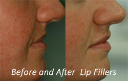 before and after lip filler- natural look