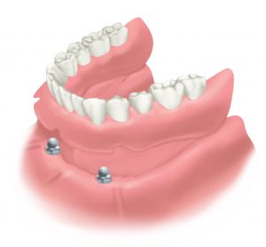 Implant Denture Stabilisation Illustration