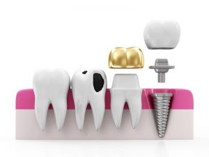 teeth, health, smile,dentist, dentalhealth, oralhealth