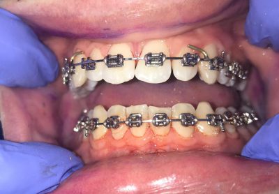 white teeth with braces on but no plaque present