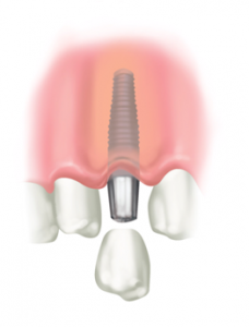 A dental implant and crown