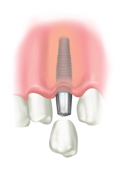 A dental implant and crown