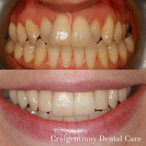 composite bonding edinburgh