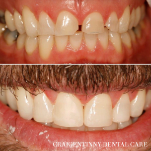 Composite Bonding Smile Makeover Resin Bonding (Composite Bonding) and Veneers