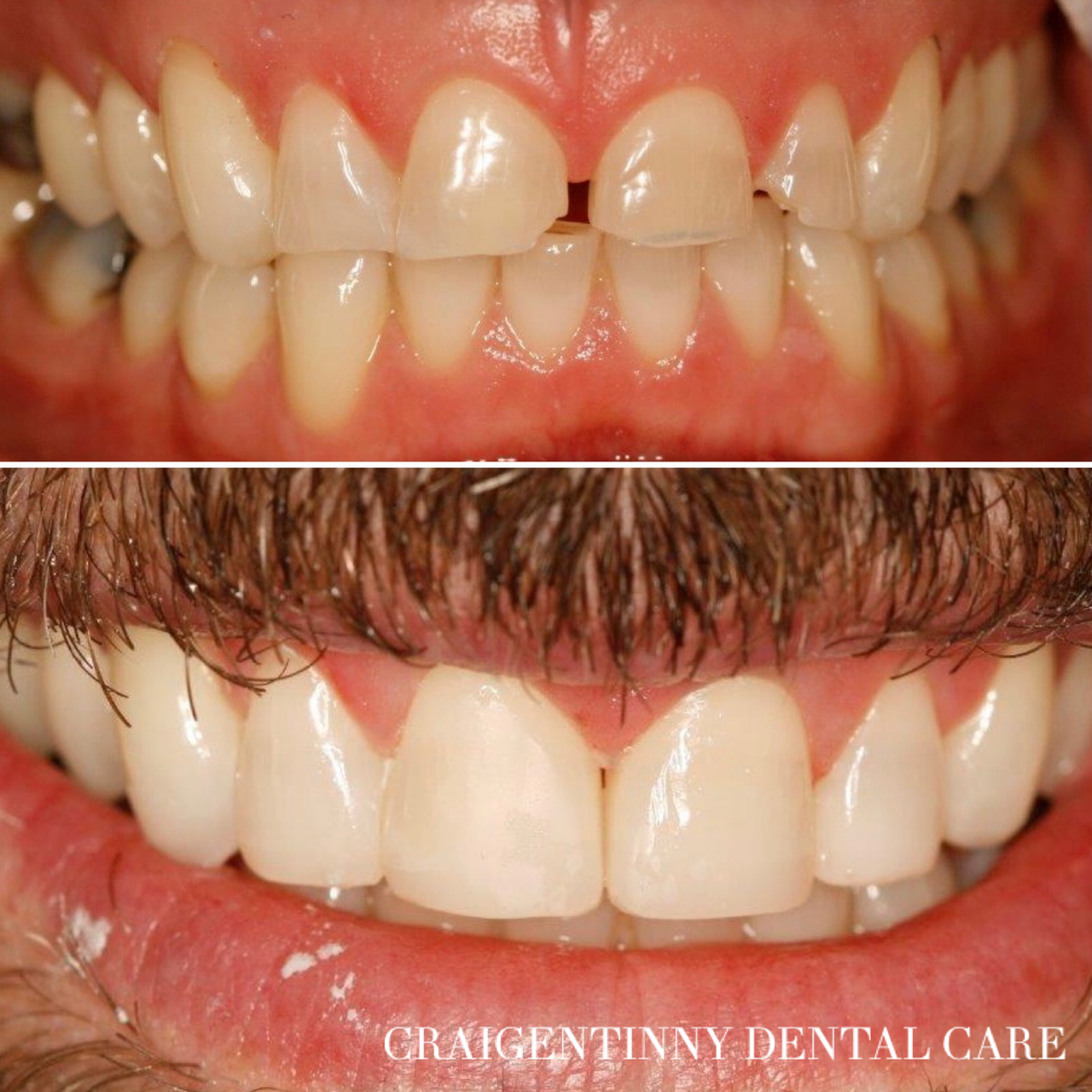 Composite Bonding Before and After Edinburgh